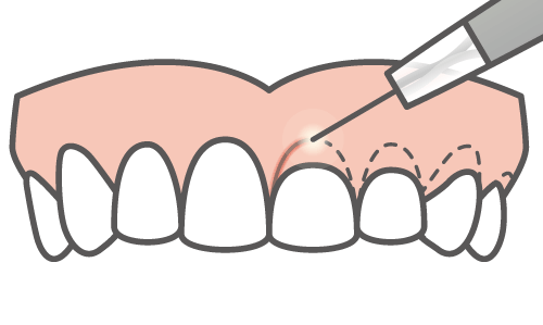 クラウンレングスニング