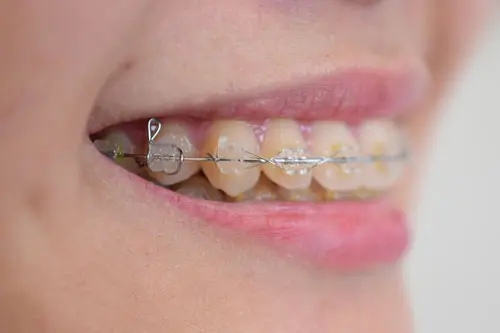 矯正中の口元