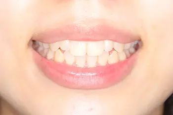 リップリポジショニング治療後口元