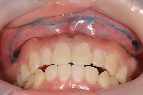 リップリポジショニング治療前