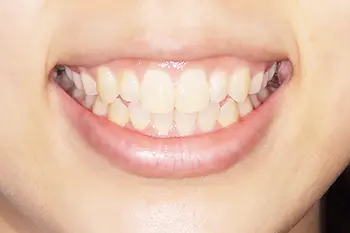 リップリポジショニング治療前口元