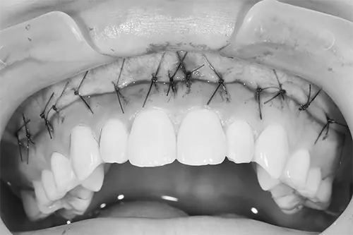 リップリポジショニング治療途中