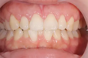 クラウンレングスニング治療後