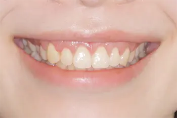 クラウンレングスニング治療前後口元