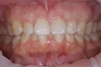 クラウンレングスニング治療前