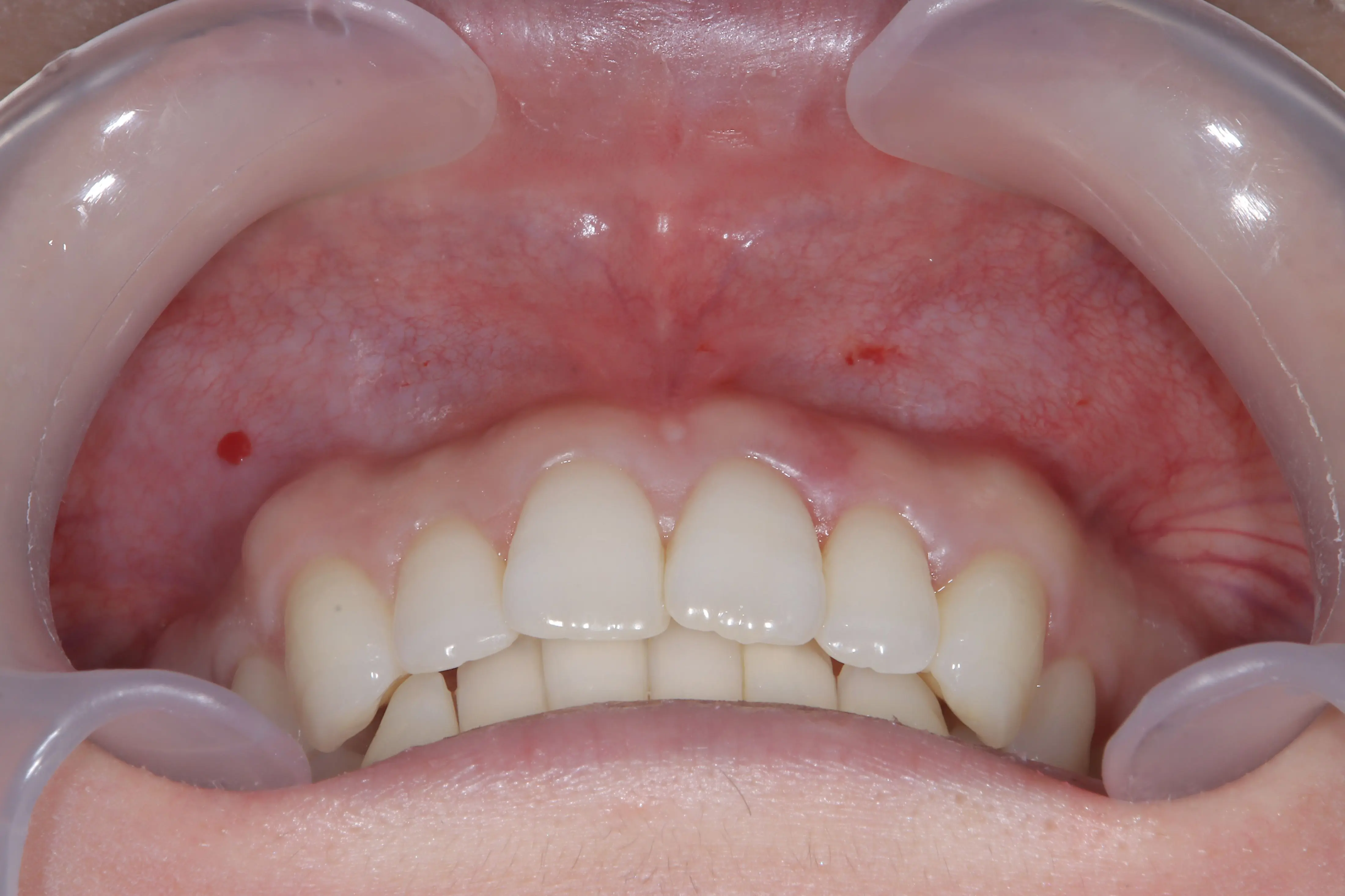 リップリポジショニング治療後