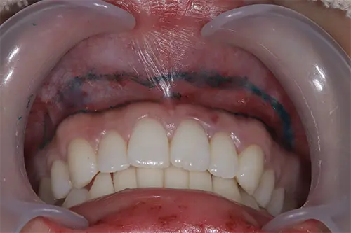 リップリポジショニング治療前