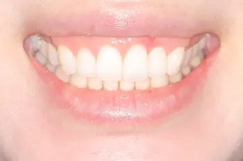 リップリポジショニング治療前口元