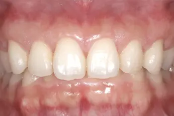 クラウンレングスニング治療後