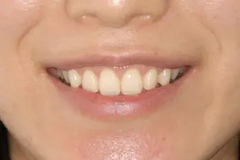 クラウンレングスニング治療前後口元