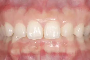 クラウンレングスニング治療前