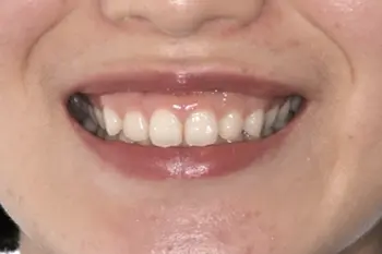 クラウンレングスニング治療前口元