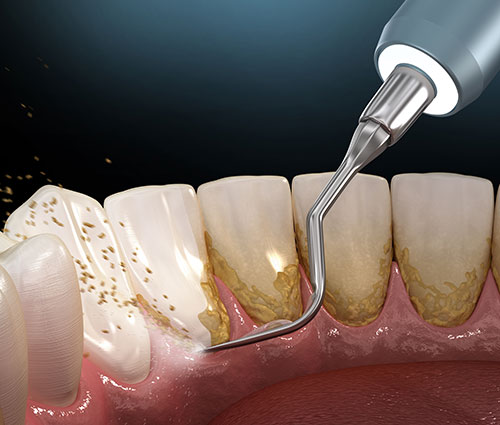 プラーク・歯石除去の基本と原則