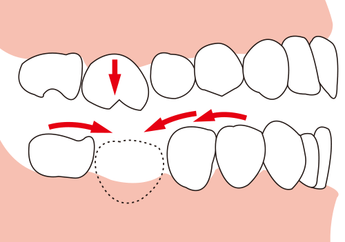 移動する歯のイメージ