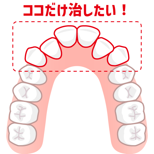 前歯のみの叢生のイラスト