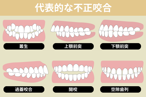 代表的な不正咬合の図解