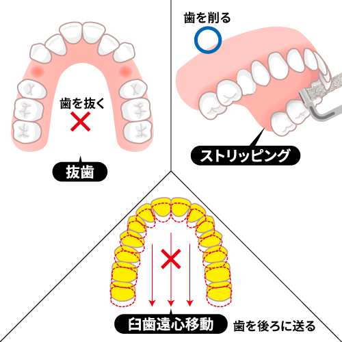 歯のスペースを作る方法の図解