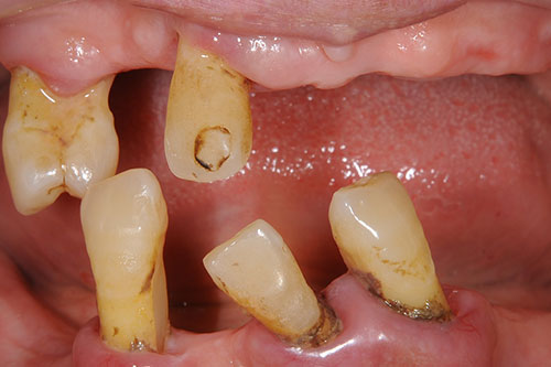 歯周病の口腔内
