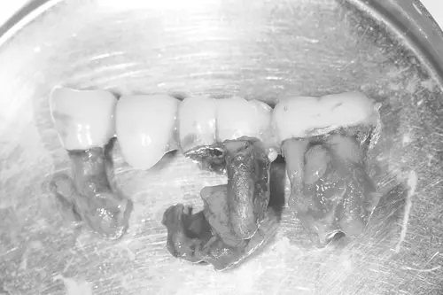 抜歯となったブリッジの支台歯