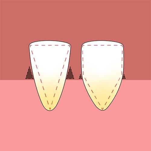 歯の形状によるブラックトライアングル