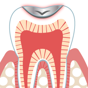 銀歯の隙間