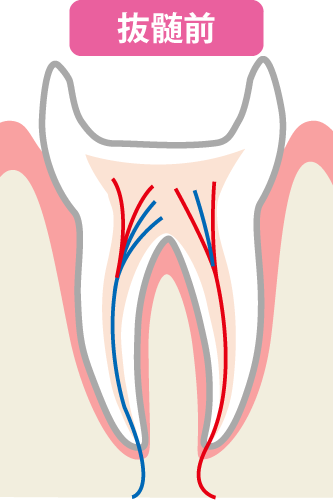 抜髄前の神経