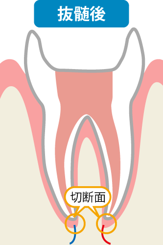 抜髄後の神経