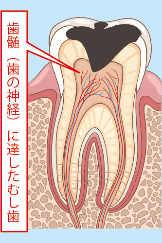 保険の根管治療後の写真