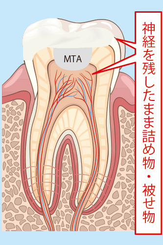 精密根管治療後の写真