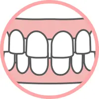 前歯のすきっ歯によって咬み合わせが悪くなるイメージ