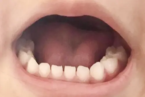 乳歯のすきっ歯