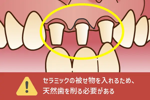 セラミック矯正は天然歯を沢山削る必要があります