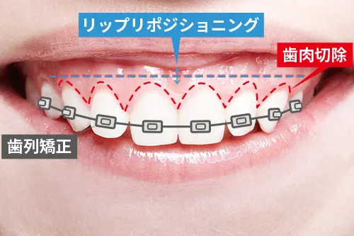 ガミースマイルの歯科アプローチ方法