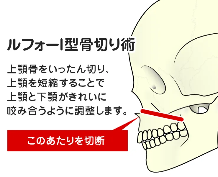 骨切り術のイメージ