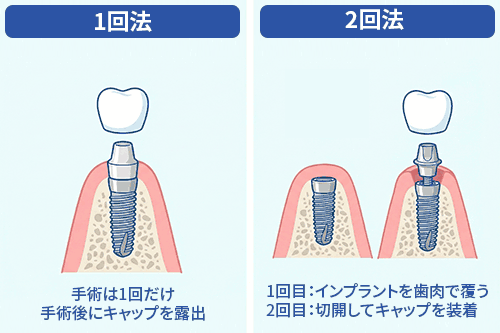1回法と2回法の違いの図解