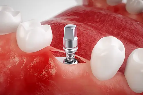 アバットメントの装着