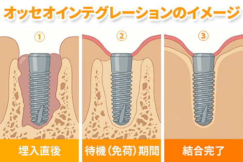 骨結合のイメージ