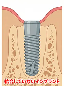 結合していないインプラント