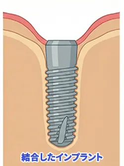 結合したインプラント