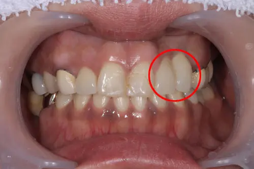 審美不良のインプラント
