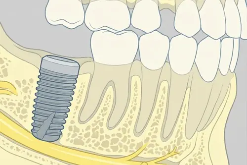 大きな神経の近くのインプラント