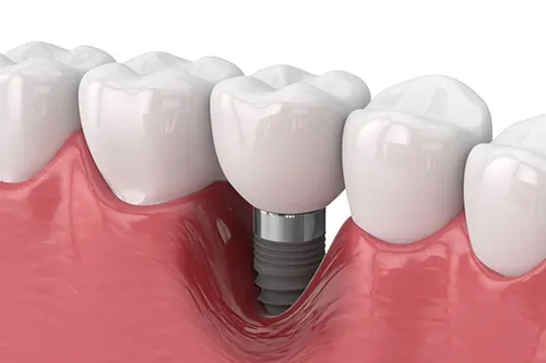 インプラント周囲炎