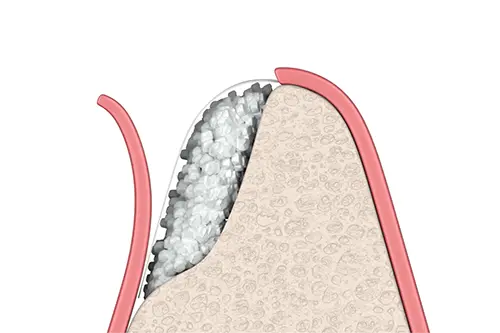 骨造成GBRの3D画像