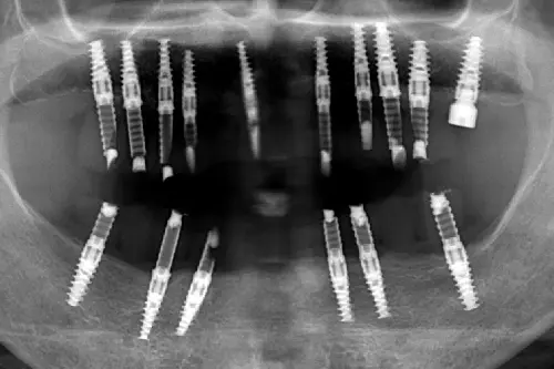 複数インプラントのレントゲン