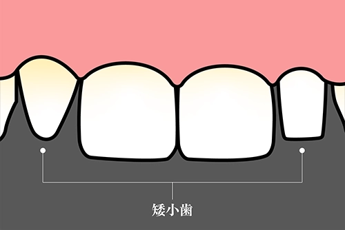 矮小歯の種類