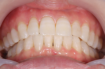 治療後の整った前歯