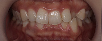 治療前の前歯